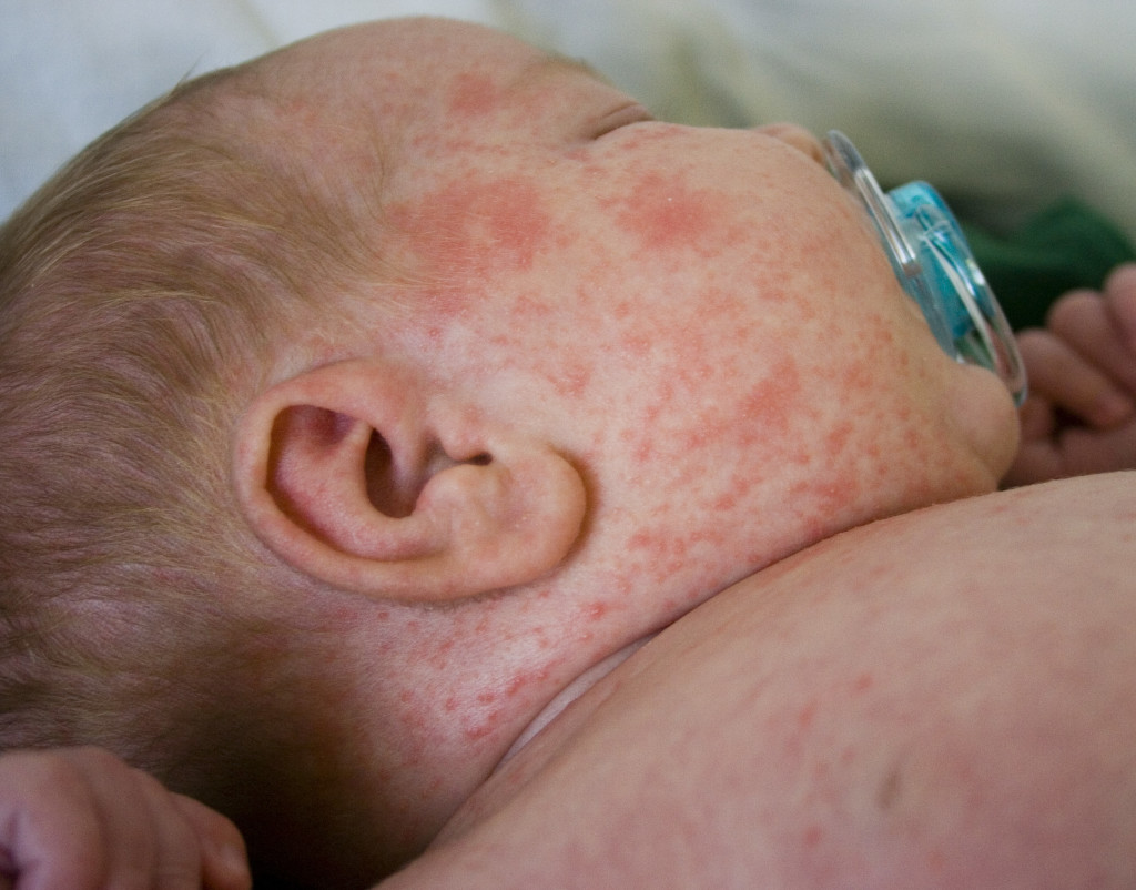 identify-measles