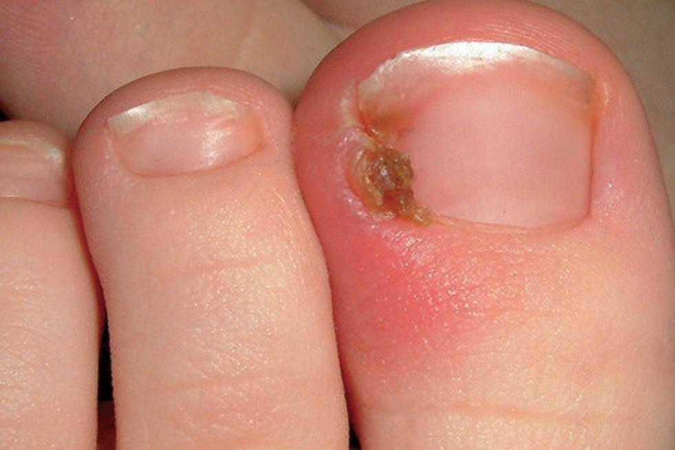 ingrown-toenail