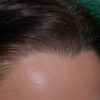 <?php echo All About Forehead Reduction Surgery; ?>