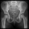 <?php echo What are Pelvic Fractures?; ?>