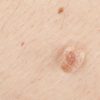 <?php echo Skin Tags, What are They?; ?>