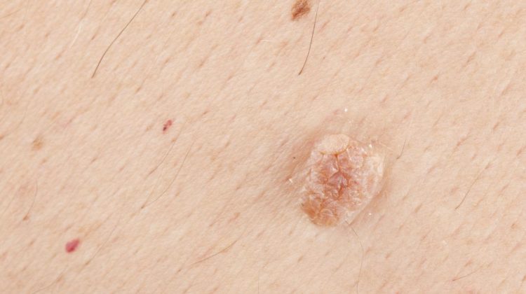 A picture of a skin tag
